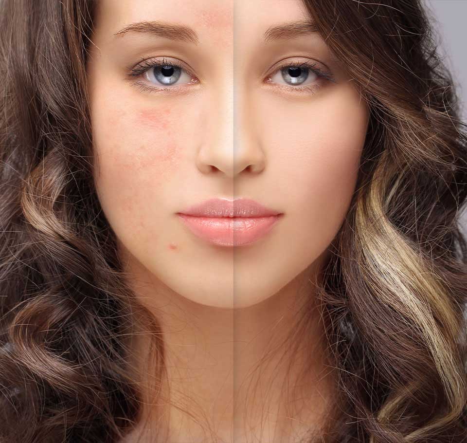 Rosacea