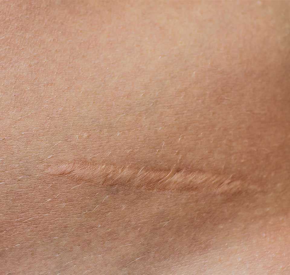 Scarring