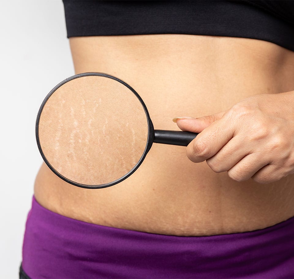 Stretch Mark Removal