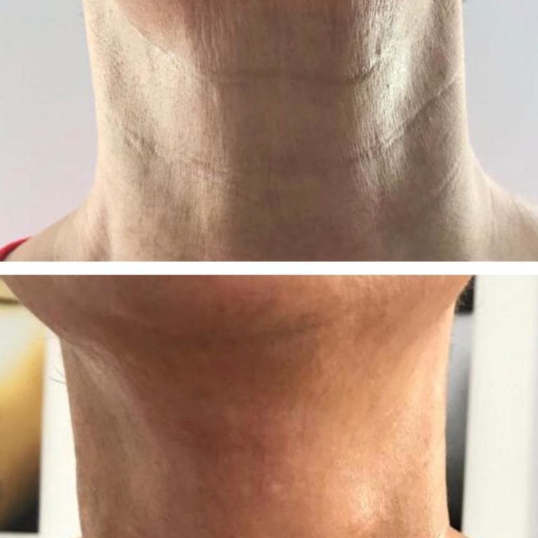 Neck Wrinkles