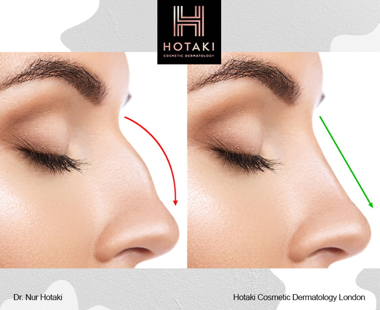 Nose Reshaping with Threads Everything you Need to Know Hotaki