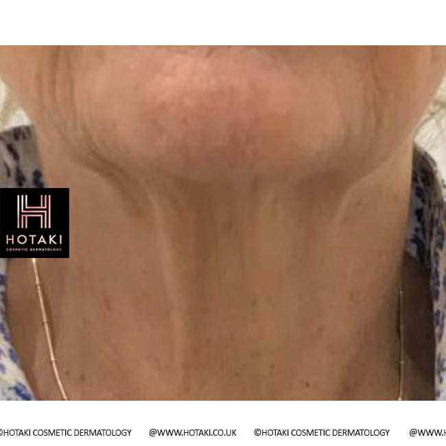 Before Non Surgical Neck Lift