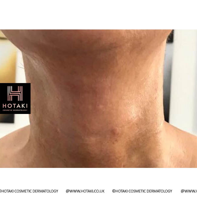 After Non Surgical Neck Lift