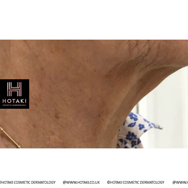 Before Non Surgical Neck Lift