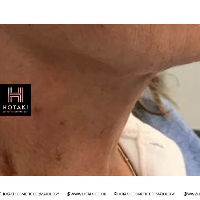After Non Surgical Neck Lift