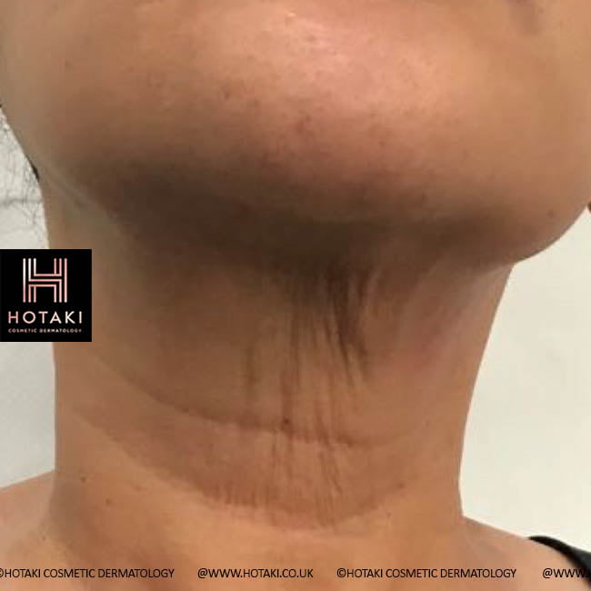 Before Non Surgical Neck Lift