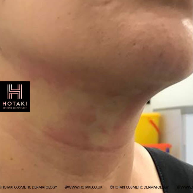 After Non Surgical Neck Lift