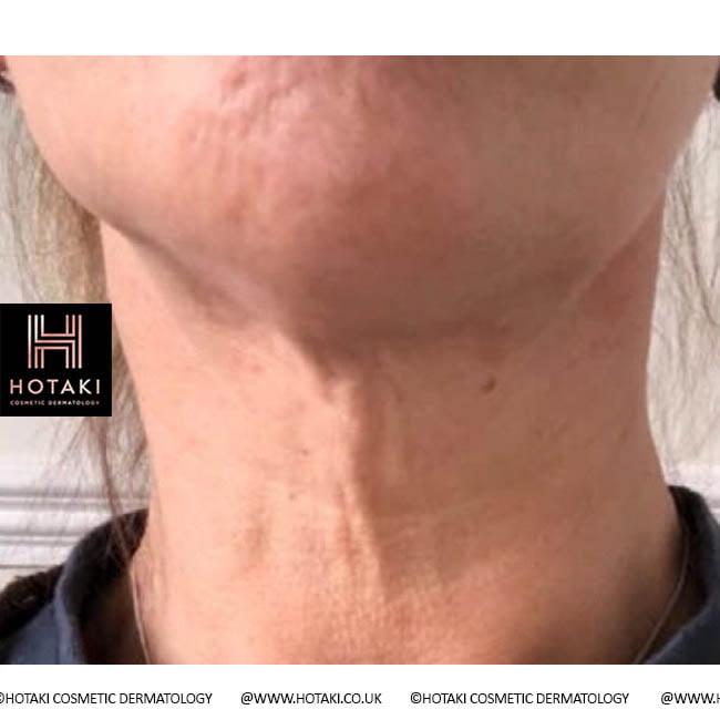 Before Non Surgical Neck Lift