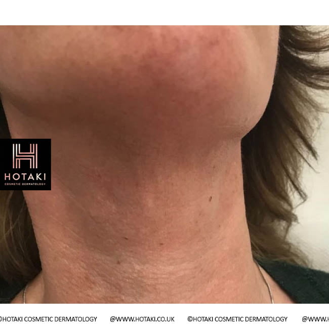 After Non Surgical Neck Lift