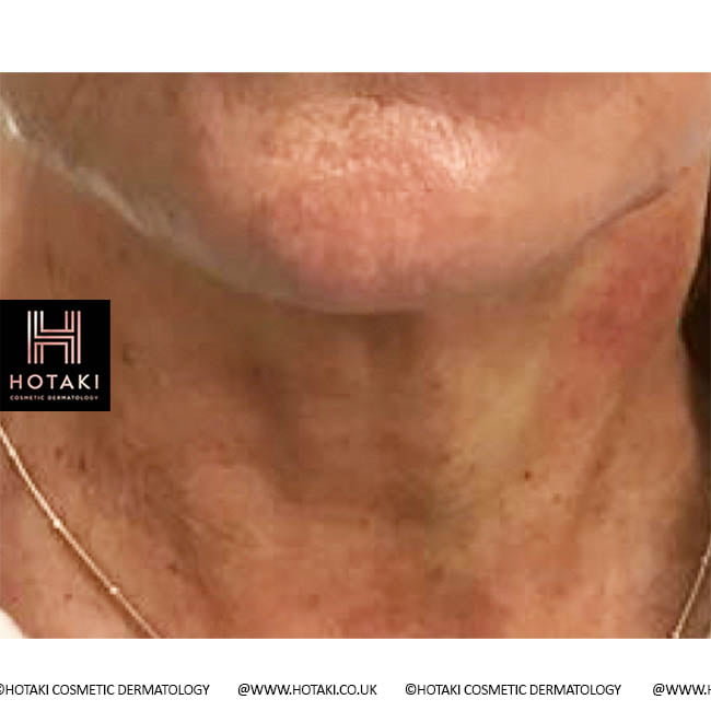 After Non Surgical Neck Lift