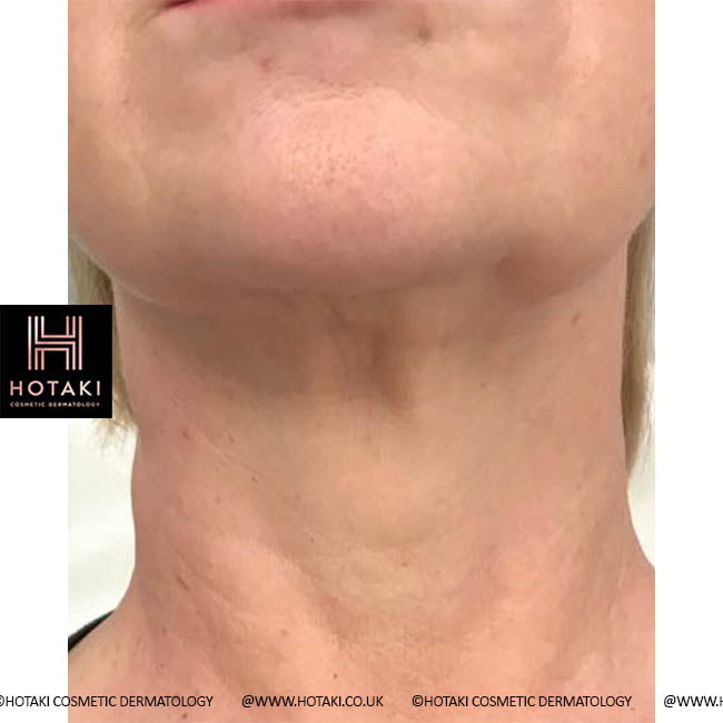 Before Non Surgical Neck Lift