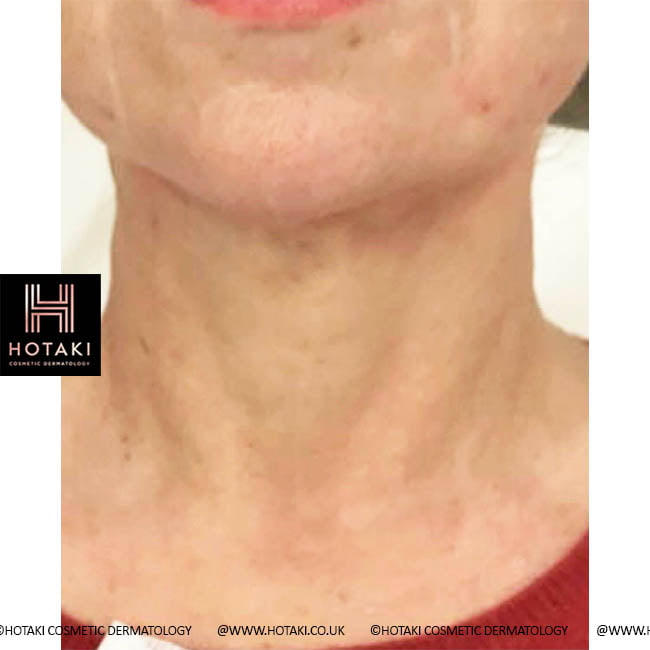 After Non Surgical Neck Lift