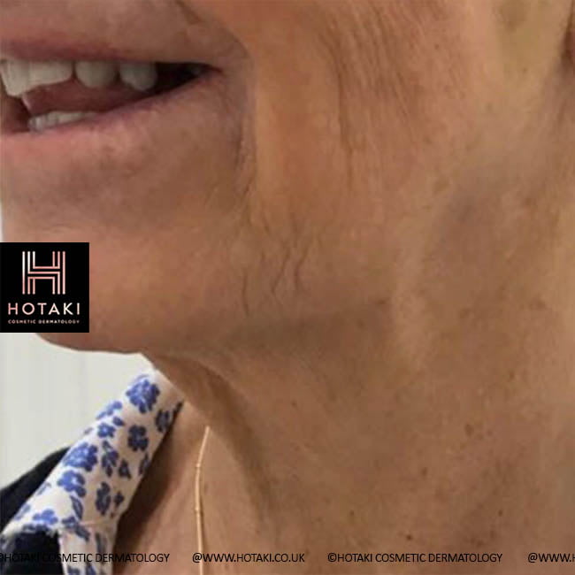 Before Non Surgical Neck Lift