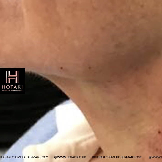 After Non Surgical Neck Lift