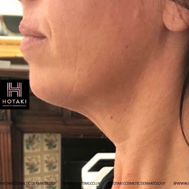 Before Non Surgical Neck Lift
