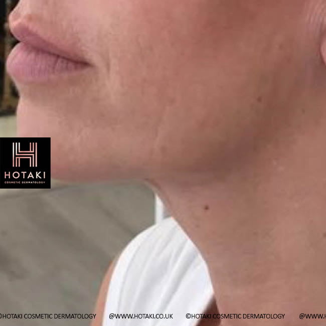 After Non Surgical Neck Lift