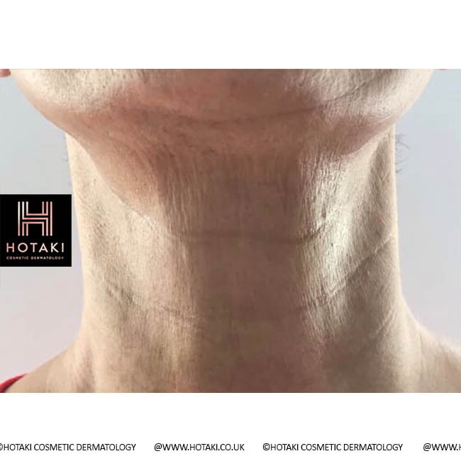Before Non Surgical Neck Lift